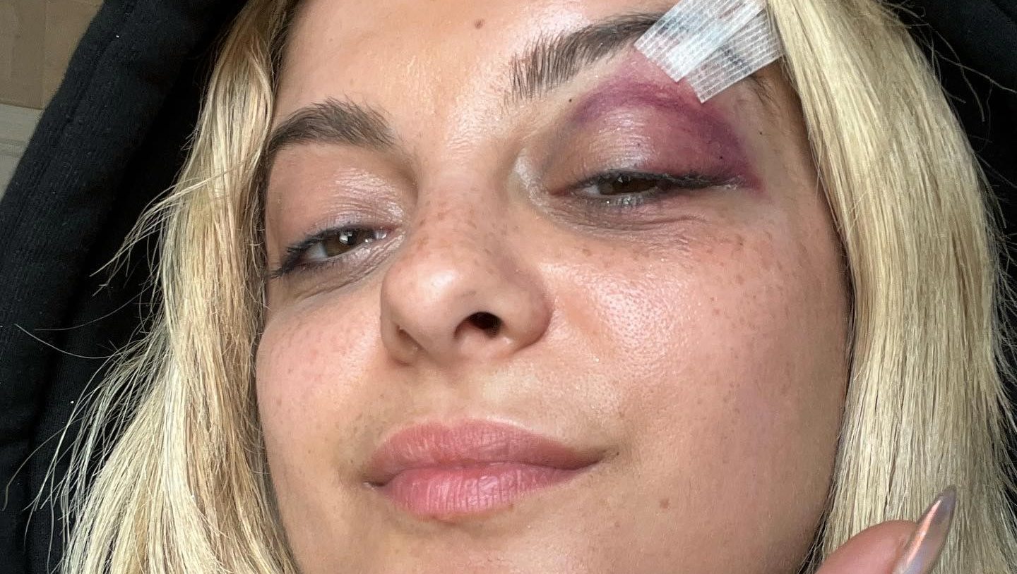 Bebe Rexha Shares Black Eye Pics After Fan Throws Phone at Her